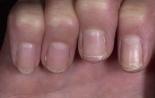 Советы для тех, у кого сильно слоятся ногти Как вылечить ногти на руках слоения