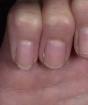 Советы для тех, у кого сильно слоятся ногти Как вылечить ногти на руках слоения
